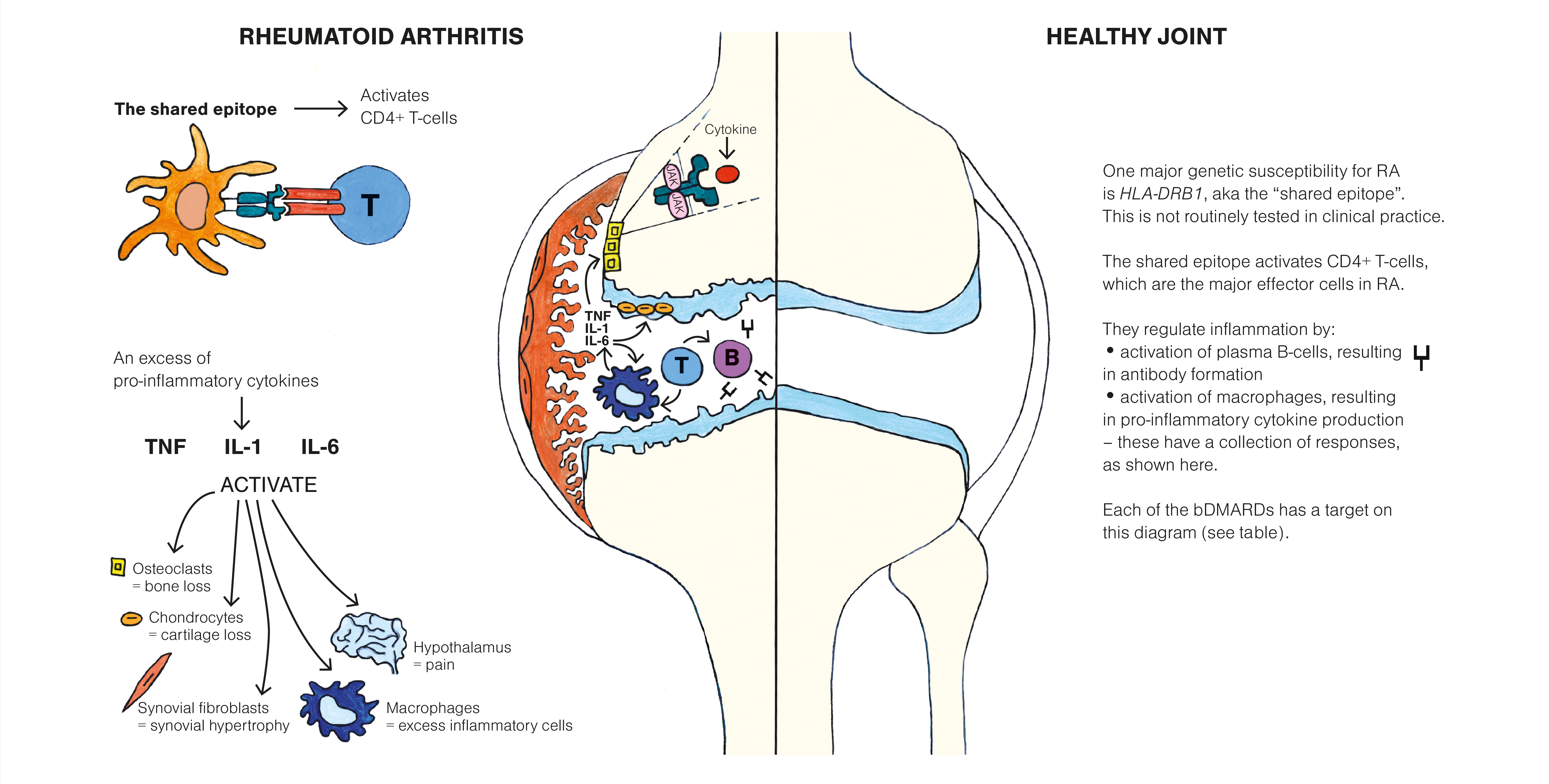 rheumatoid arthritis pathophysiology