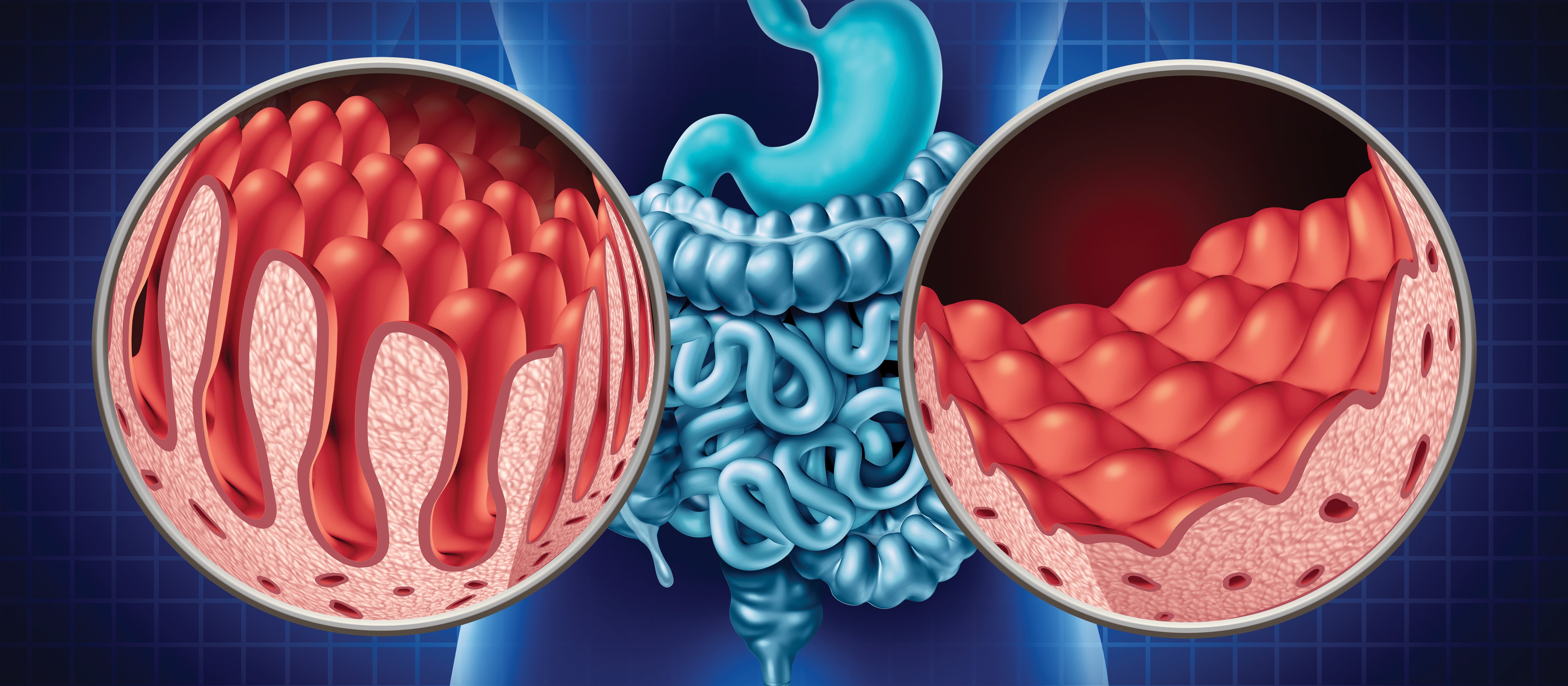 ceoliac disease - small intestine damage