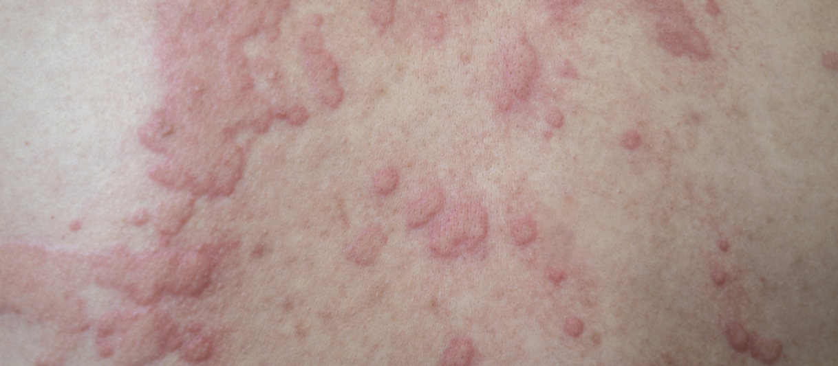 rash that get iritaed from touching it