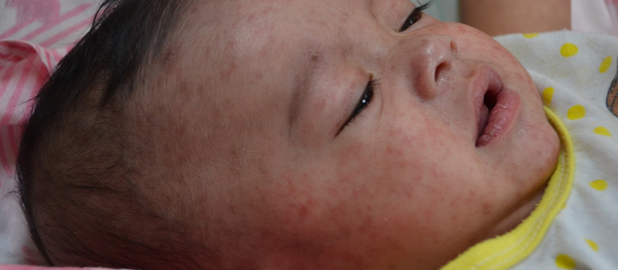 Child with measles