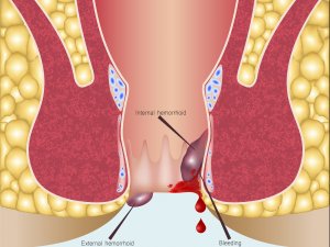 Haemorrhoids