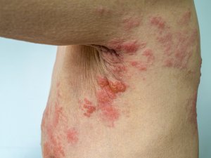 Shingles rash