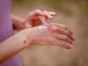 Eczema